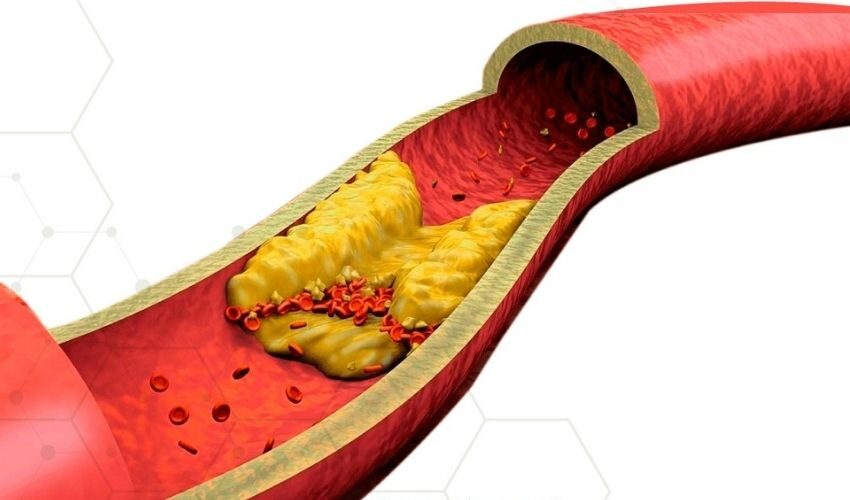 gordura acumulada em uma artéria impedindo a passagem de sangue que pode provocar doenças cardiovasculares